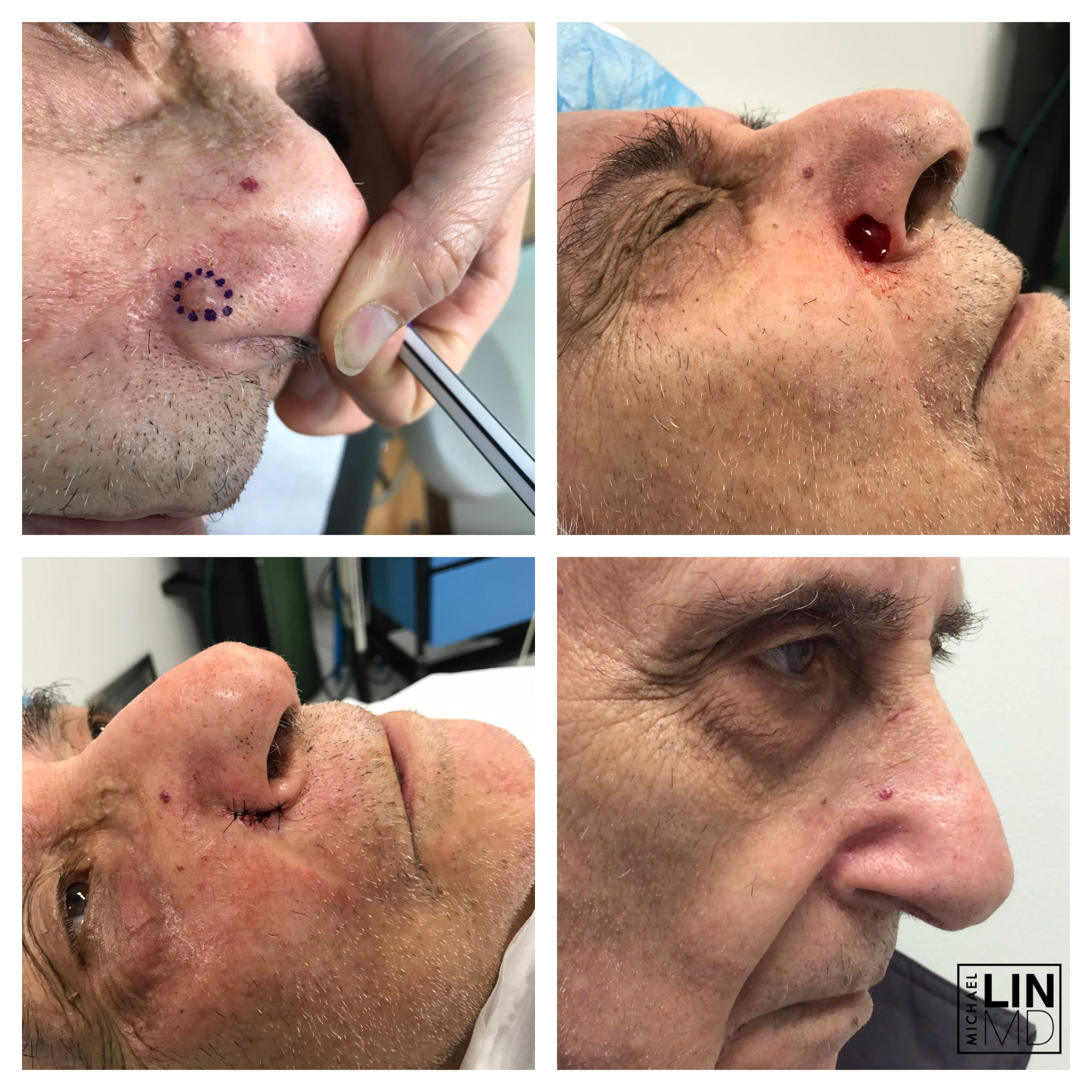 Circular incision on a man's nose
