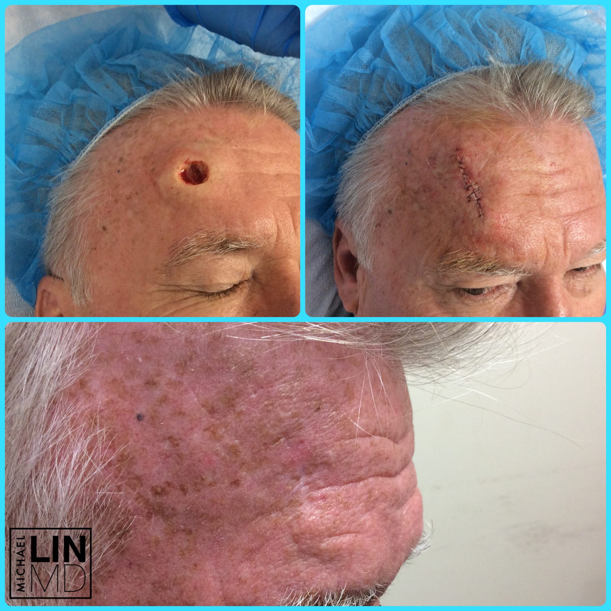 Circular incision on a man's forehead