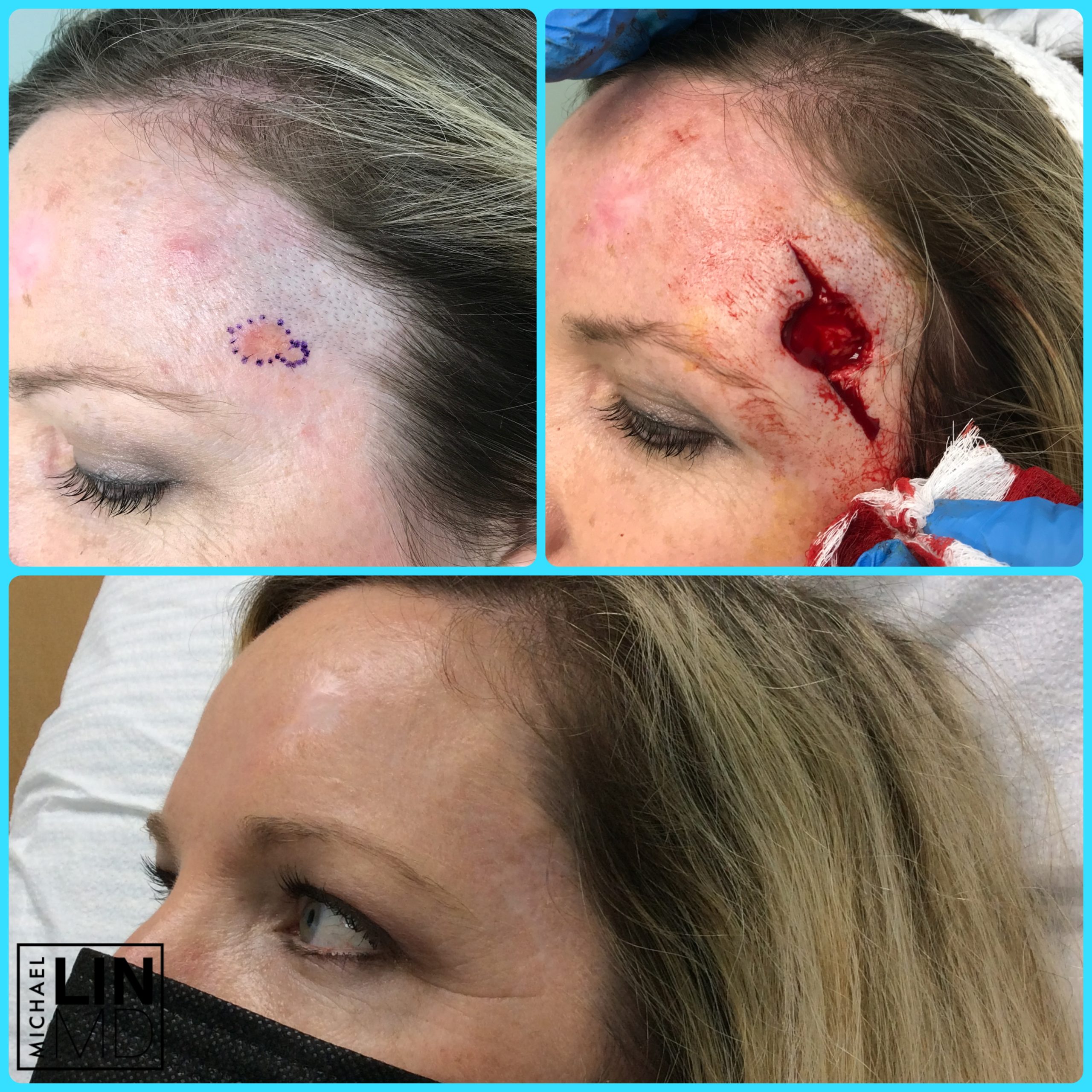 Deep circular incision on a woman's forehead